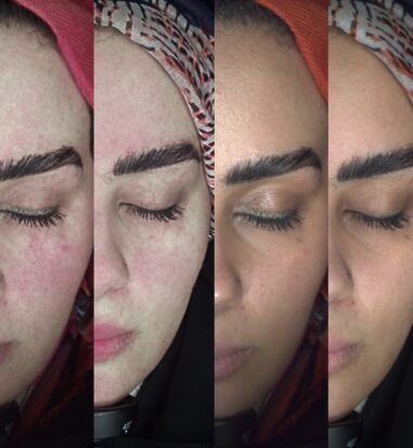 thumb1 profile treatments