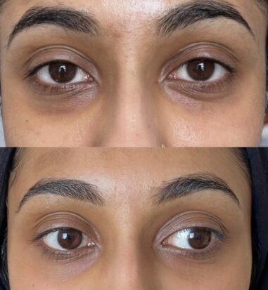 building collagen creates long lasting natural results